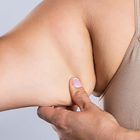 Bat Wings treatment options at SF Bay Cosmetic Surgery Medical Group in San Ramon