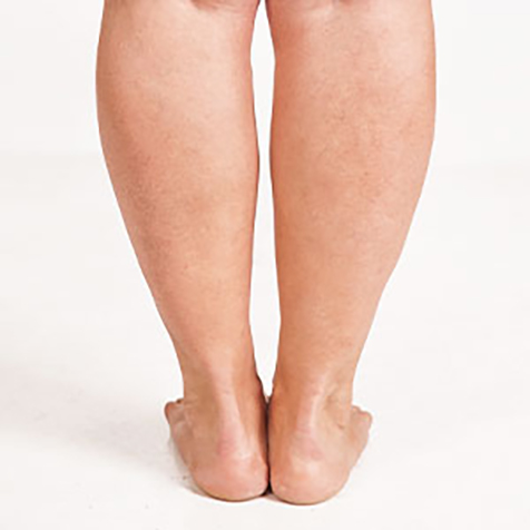 Cankles treatment options at SF Bay Cosmetic Surgery Medical Group in San Ramon