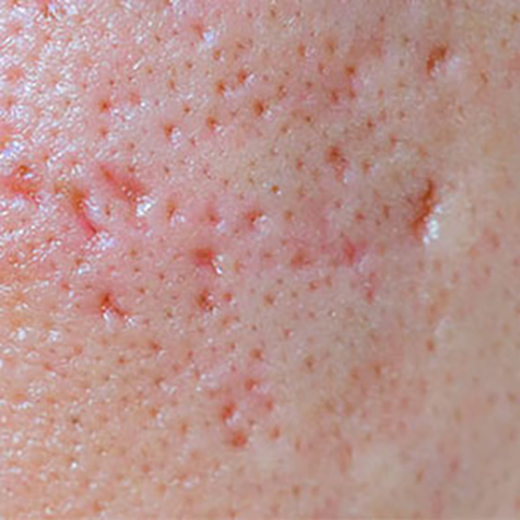 Enlarged Oil Glands & Pores treatment options at SF Bay Cosmetic Surgery Medical Group in San Ramon