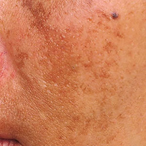 Melasma treatment options at SF Bay Cosmetic Surgery Medical Group in San Ramon