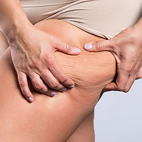 Saddle Bags treatment options at SF Bay Cosmetic Surgery Medical Group in San Ramon