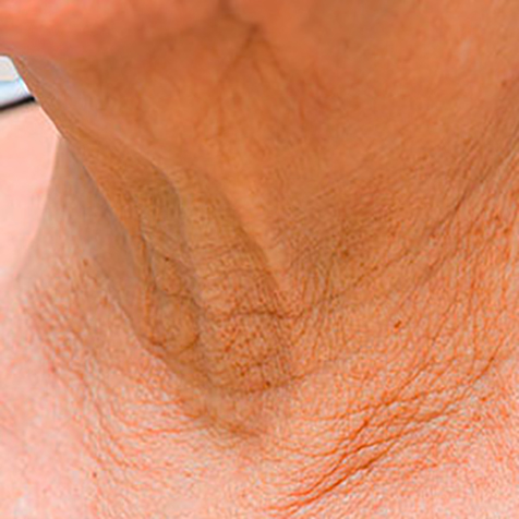 Saggy Skin treatment options at SF Bay Cosmetic Surgery Medical Group in San Ramon