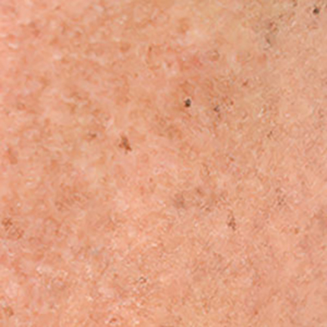 Sun Damage treatment options at SF Bay Cosmetic Surgery Medical Group in San Ramon