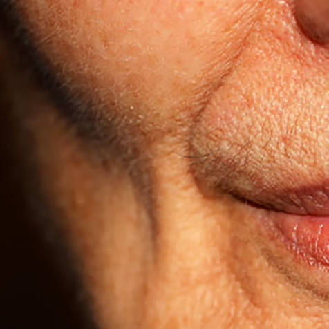 Sunken Cheeks treatment options at SF Bay Cosmetic Surgery Medical Group in San Ramon