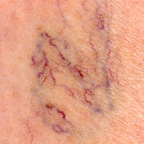 Telangiectasias treatment options at SF Bay Cosmetic Surgery Medical Group in San Ramon