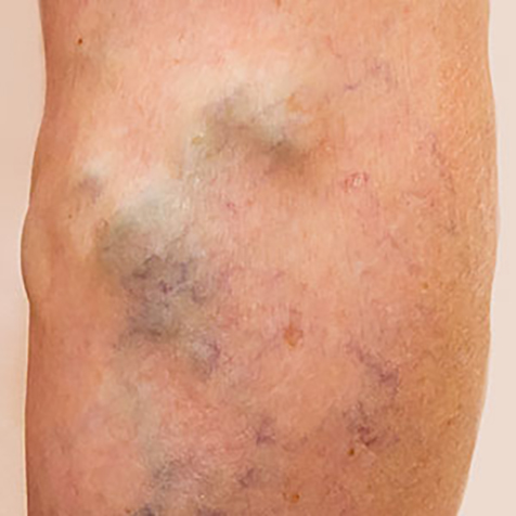 Varicose Veins treatment options at SF Bay Cosmetic Surgery Medical Group in San Ramon