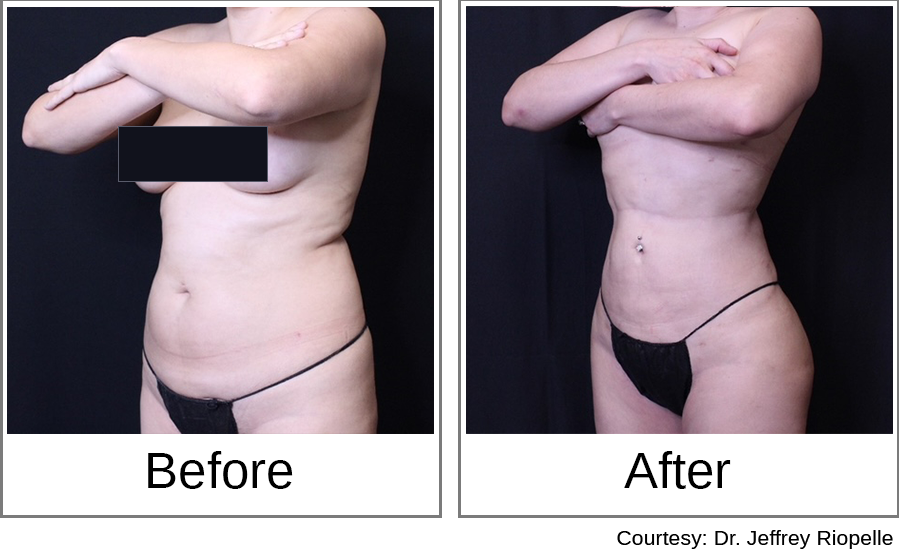 Brazilian Butt Lift Before and After 1