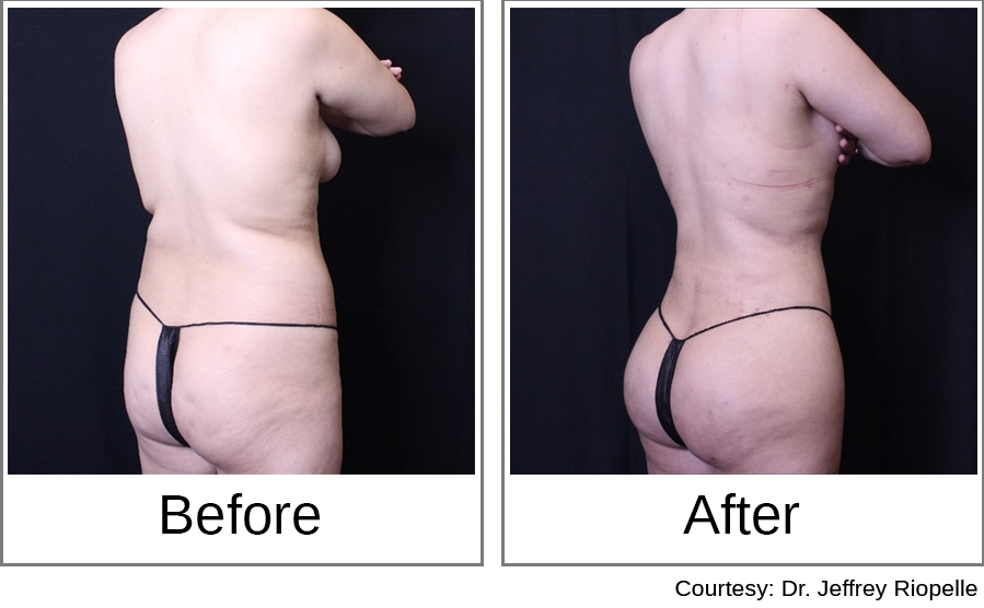 Brazilian Butt Lift Before and After 3