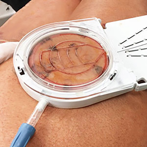 Treat cottage-cheese thighs with our Cellfina® at SF Bay Cosmetic Surgery Medical Group in San Ramon