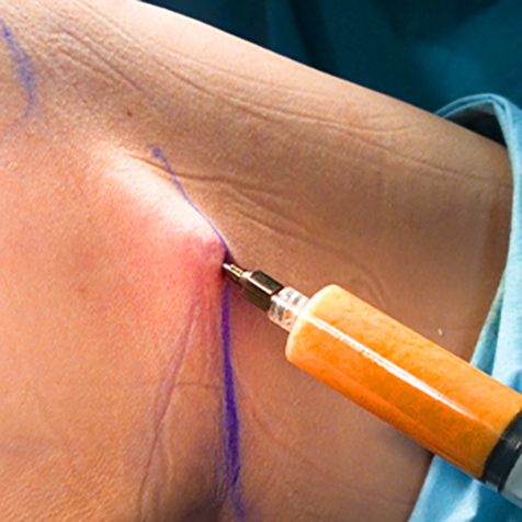 Treat jowls with our Fat Transfers at SF Bay Cosmetic Surgery Medical Group in San Ramon