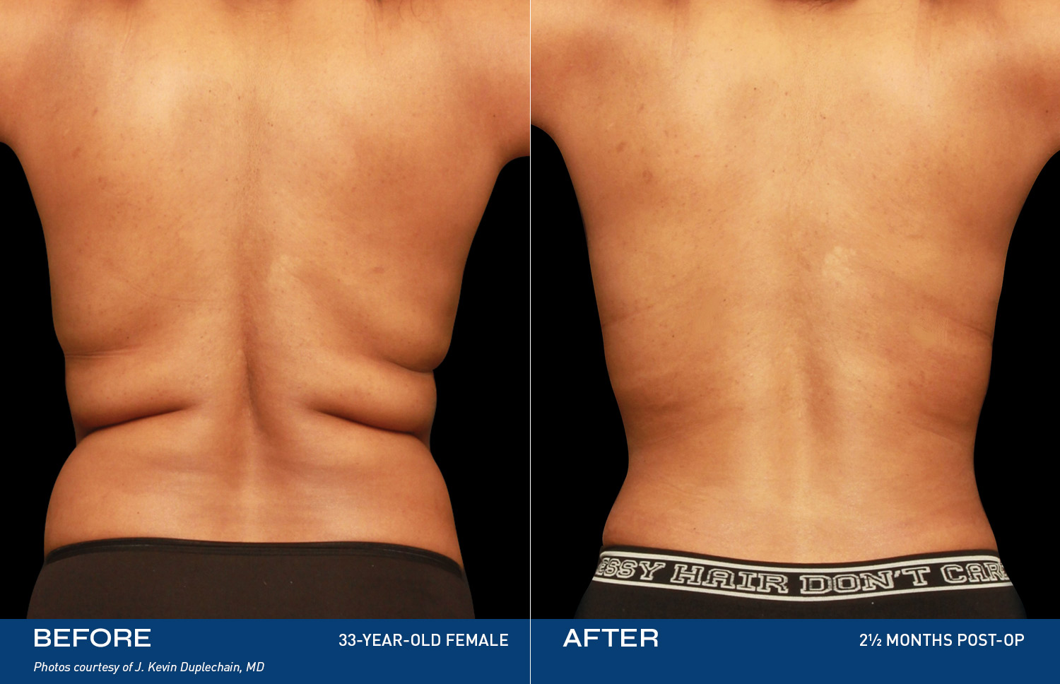 Renuvion Treatment Areas