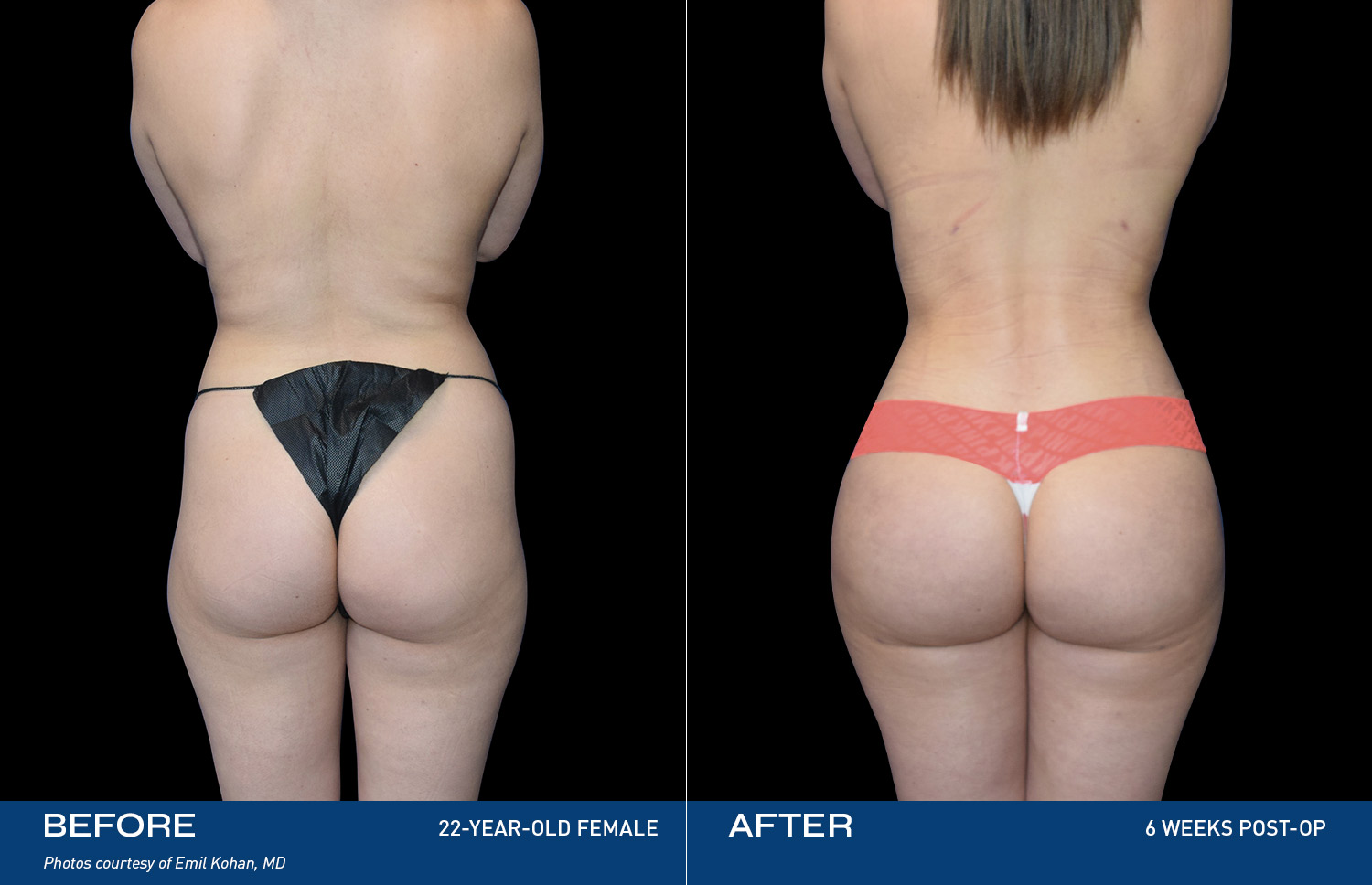 Renuvion Treatment Areas