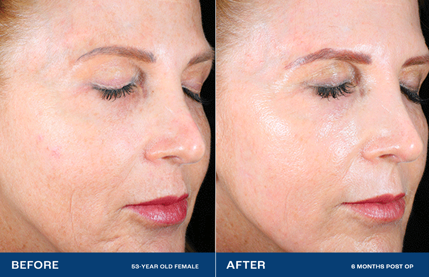 Renuvion Treatment Areas