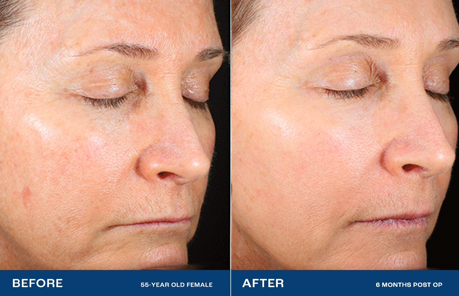 Renuvion Treatment Areas