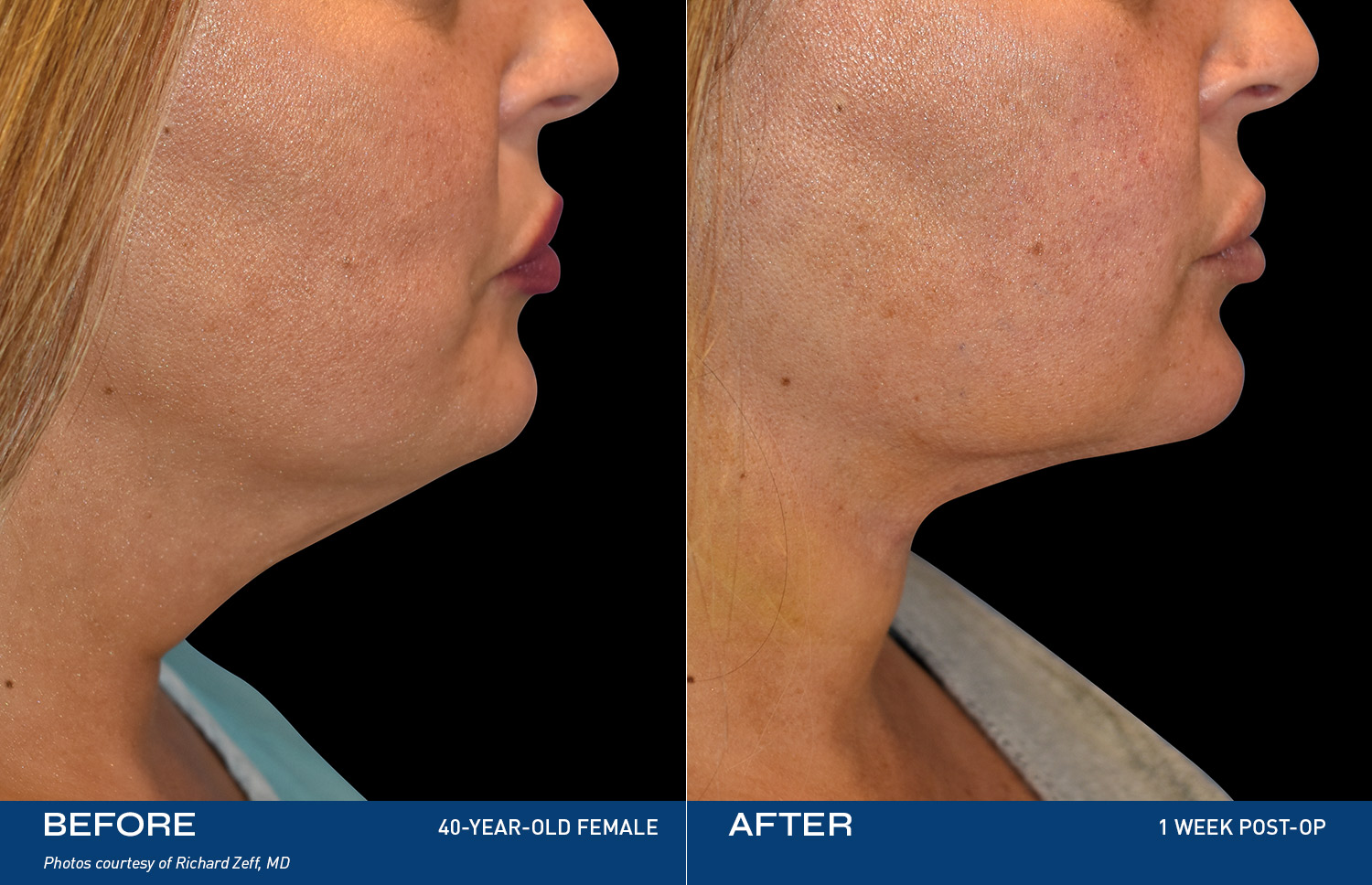 Renuvion Treatment Areas