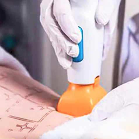 Treat bat wings with our Thermage® Body at SF Bay Cosmetic Surgery Medical Group in San Ramon