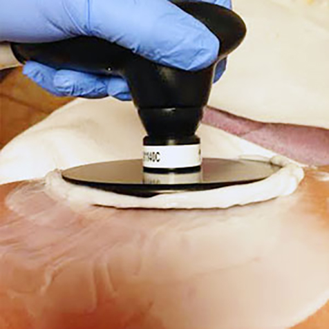 Treat cottage-cheese thighs with our ThermiSmooth® Body at SF Bay Cosmetic Surgery Medical Group in San Ramon