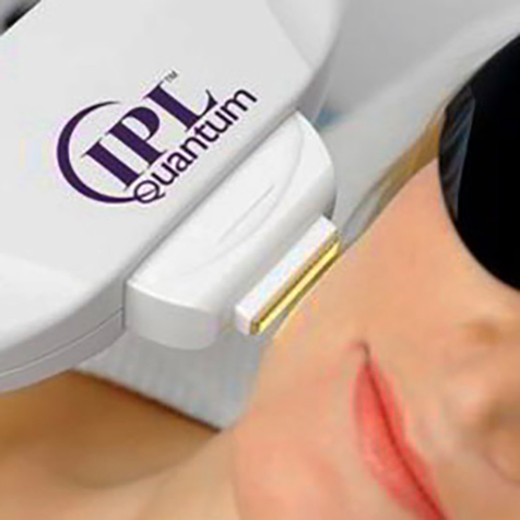 Treat Angiomass with our IPL Photo Facial at SF Bay Cosmetic Surgery Medical Group in San Ramon