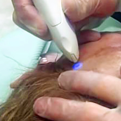 Treat uneven skin texture with our JPlasma Portrait at SF Bay Cosmetic Surgery Medical Group in San Ramon