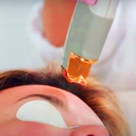 Treat angiomas with our LaserGenesis® at SF Bay Cosmetic Surgery Medical Group in San Ramon